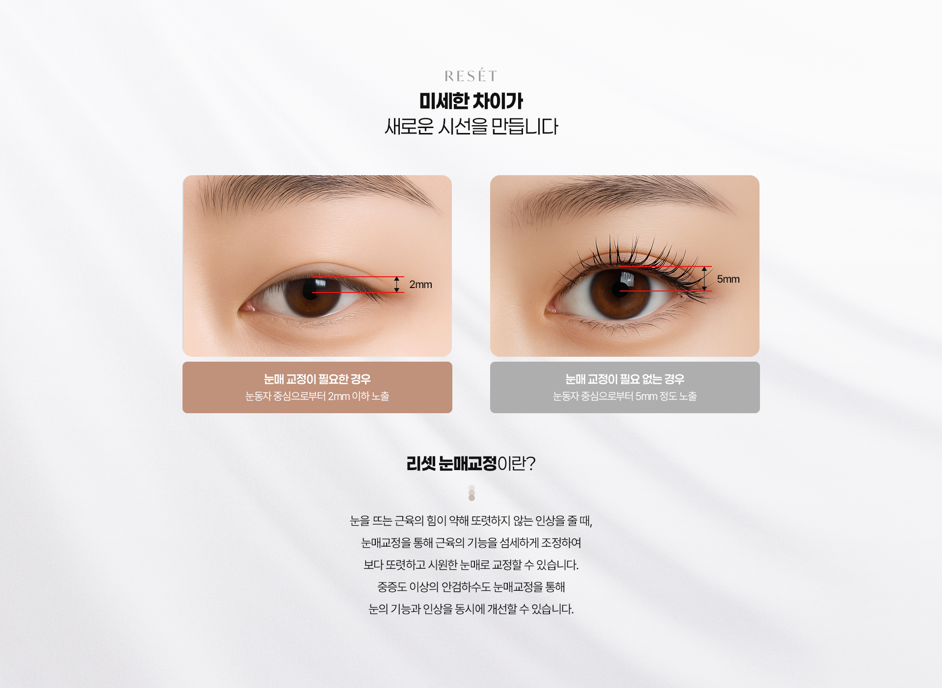 눈매교정 02