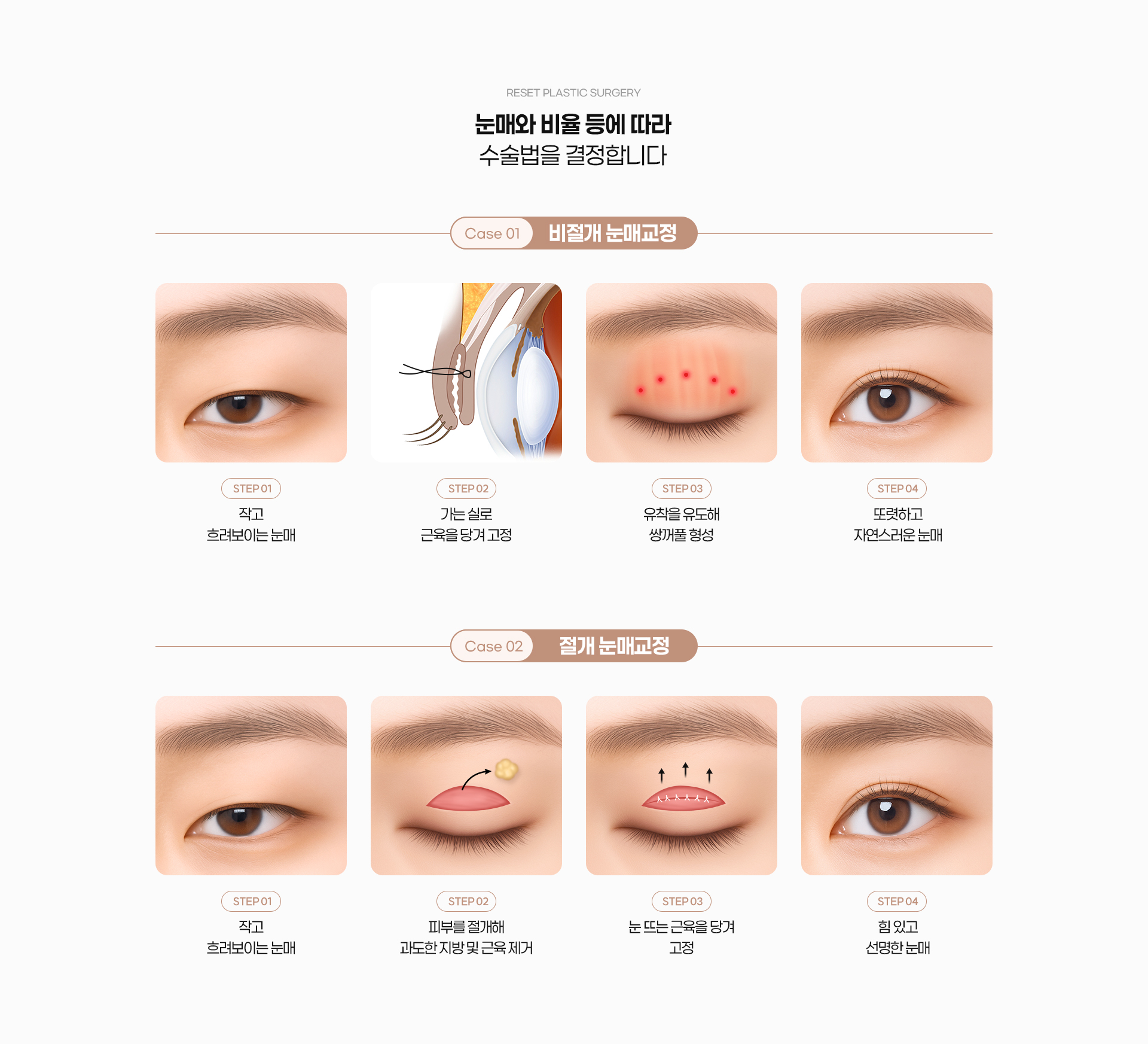 눈매교정 04