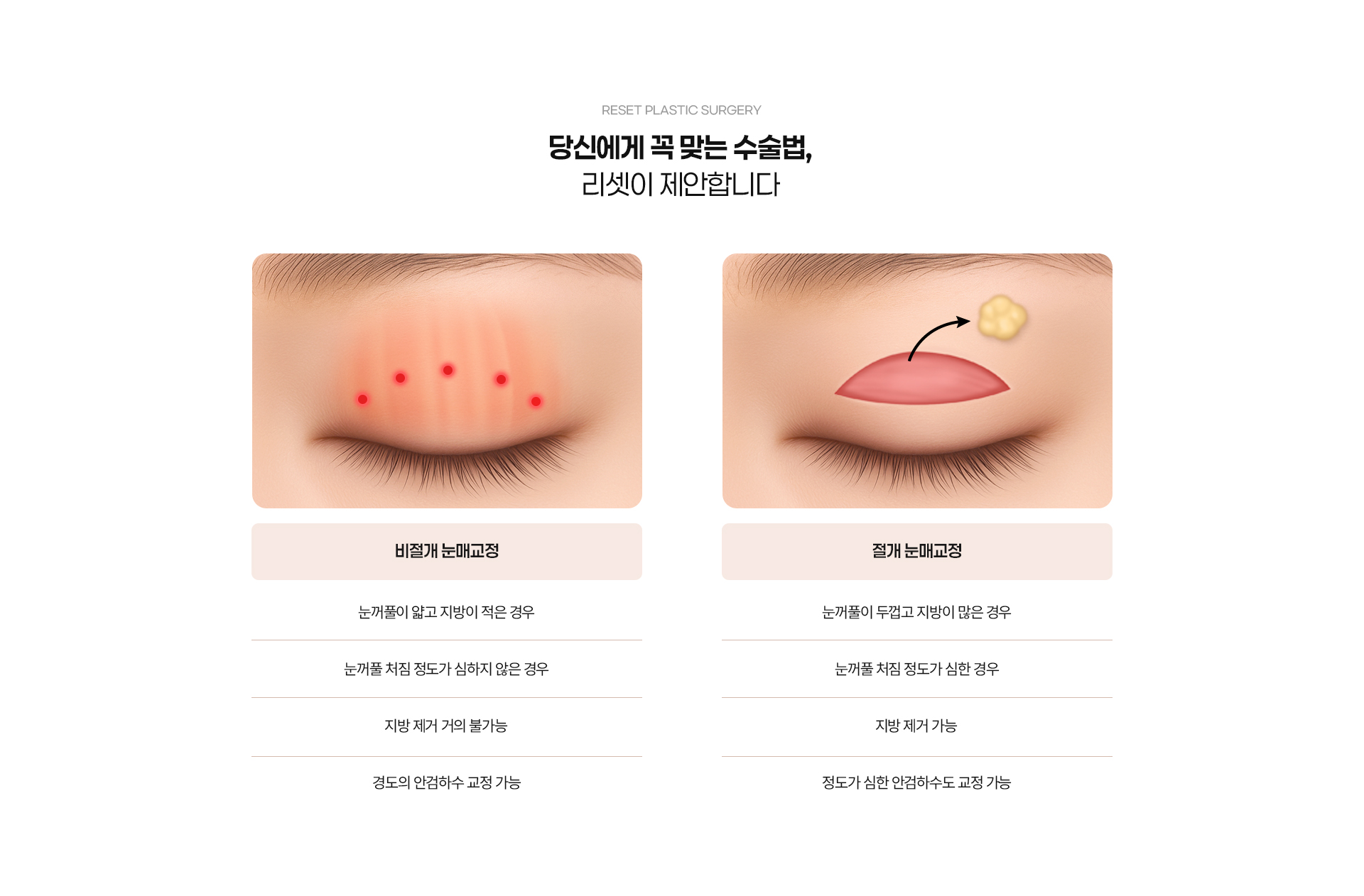 눈매교정 05
