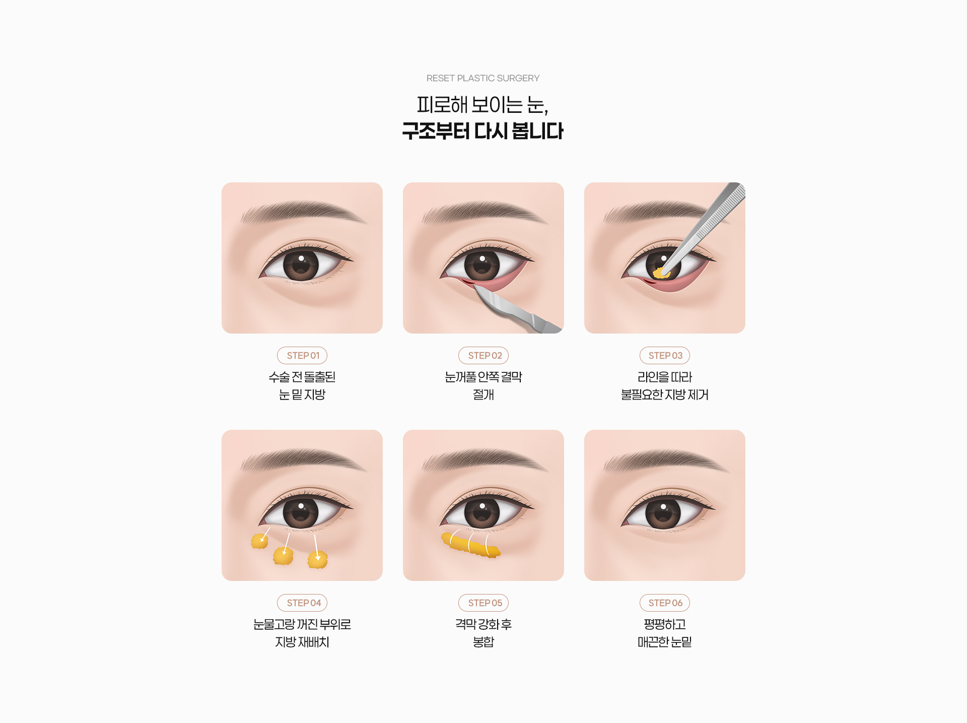 눈밑지방재배치 04