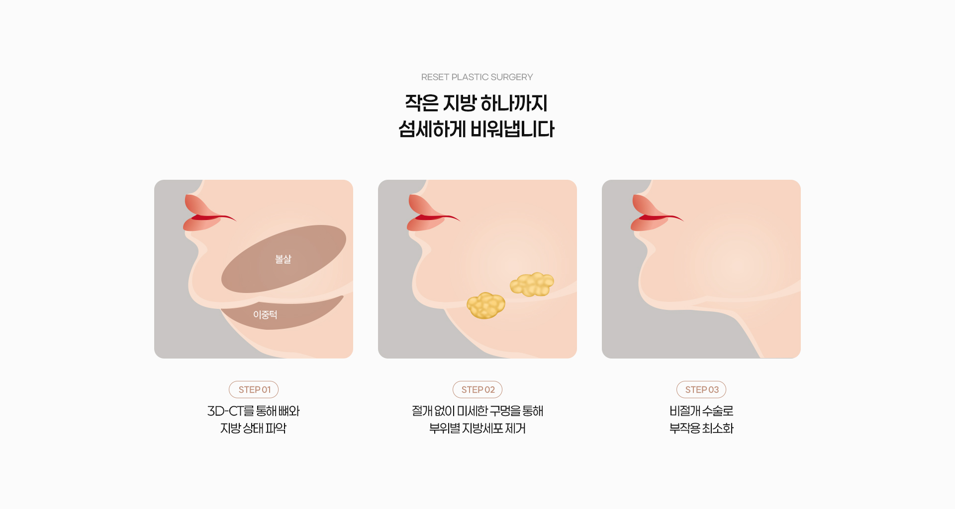 미세얼굴지방흡입 04