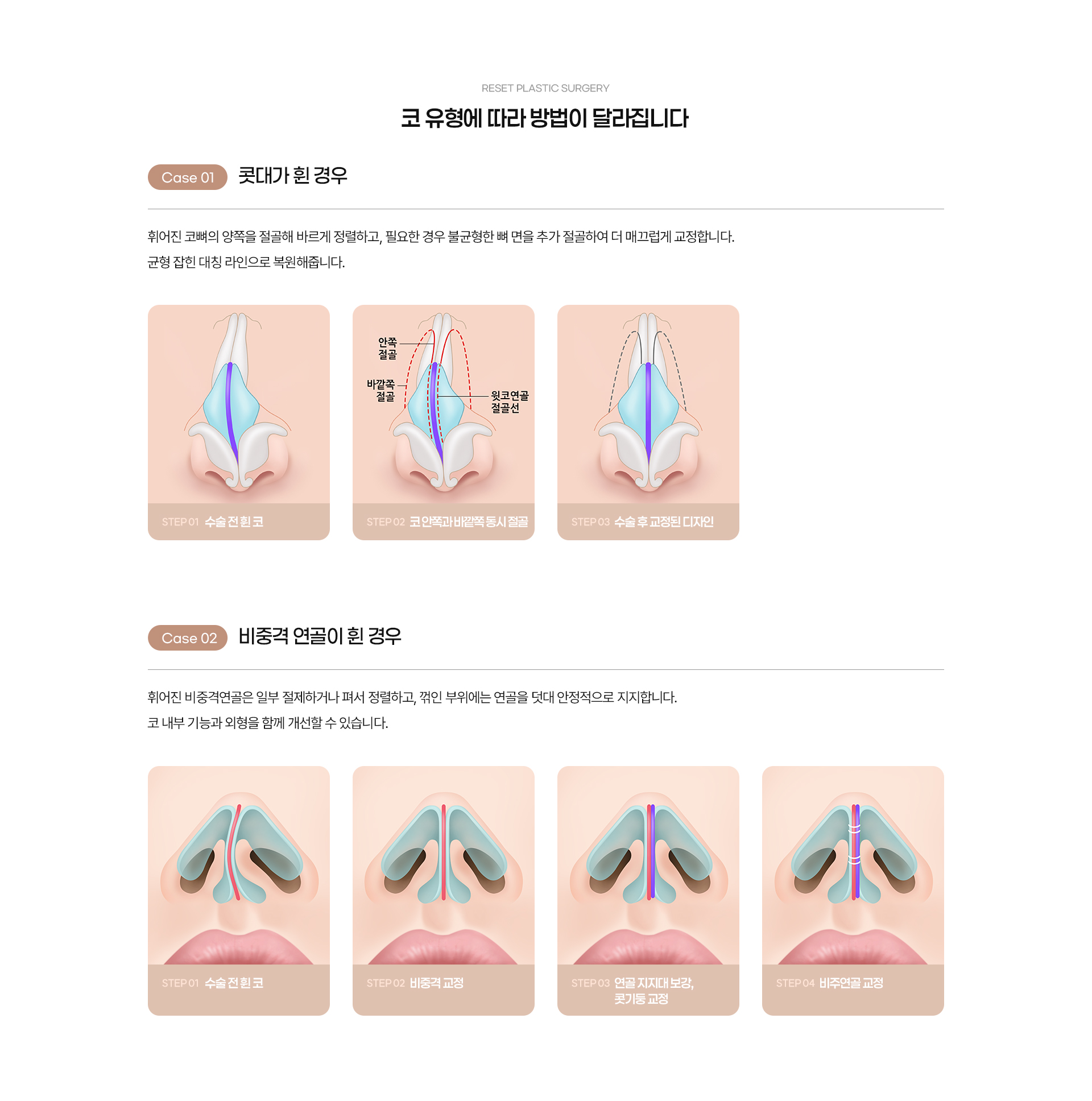 휜코 05