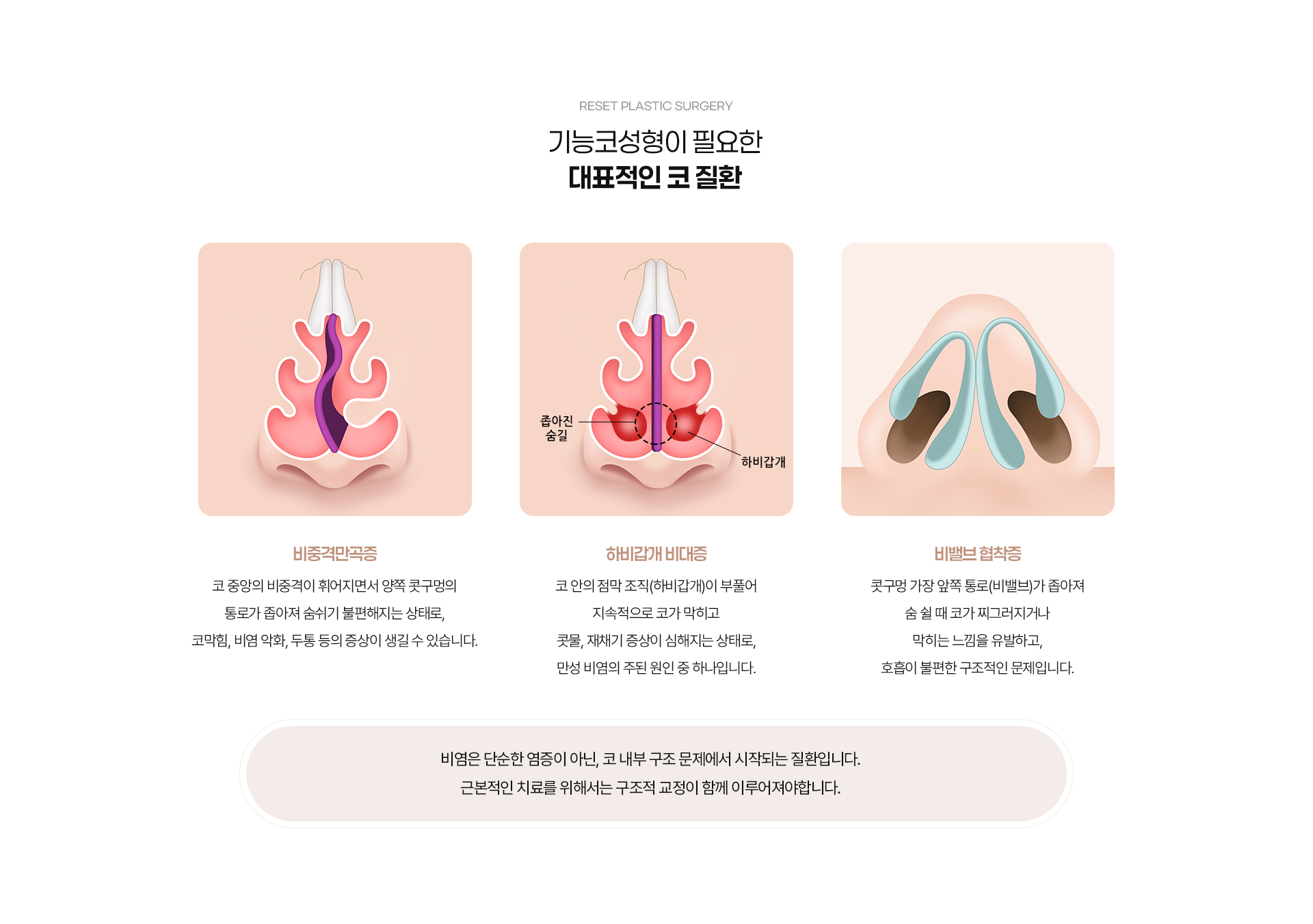 기능코성형 03