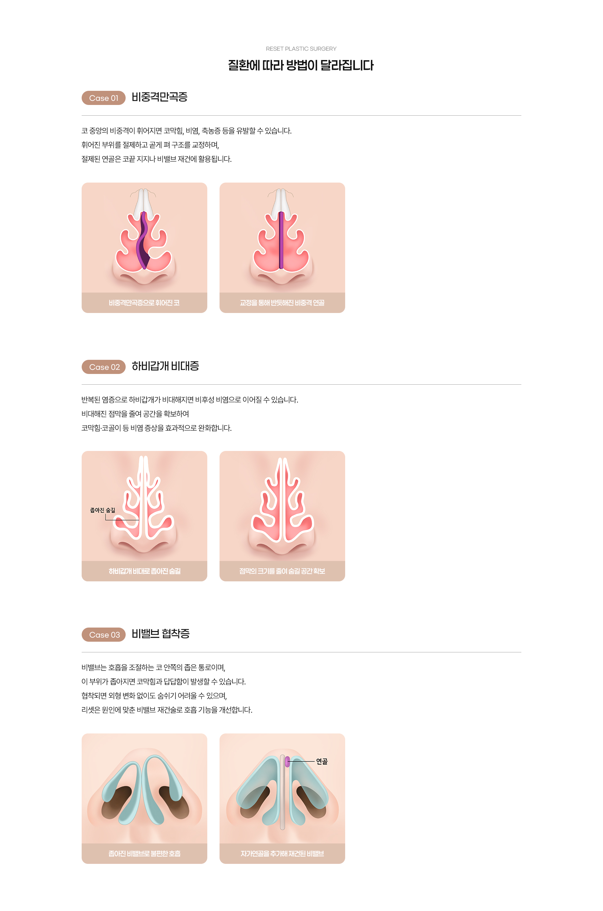 기능코성형 09