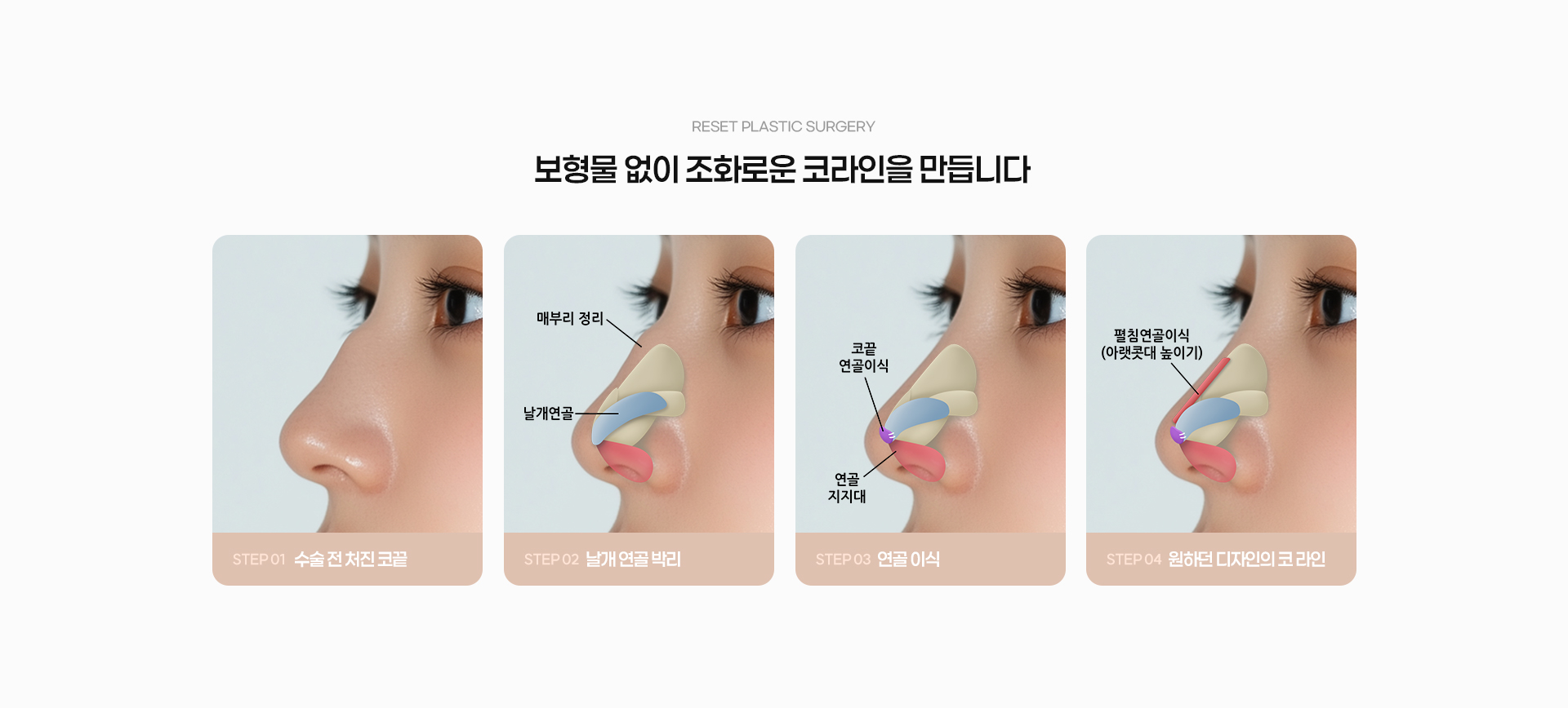 무보형물 04