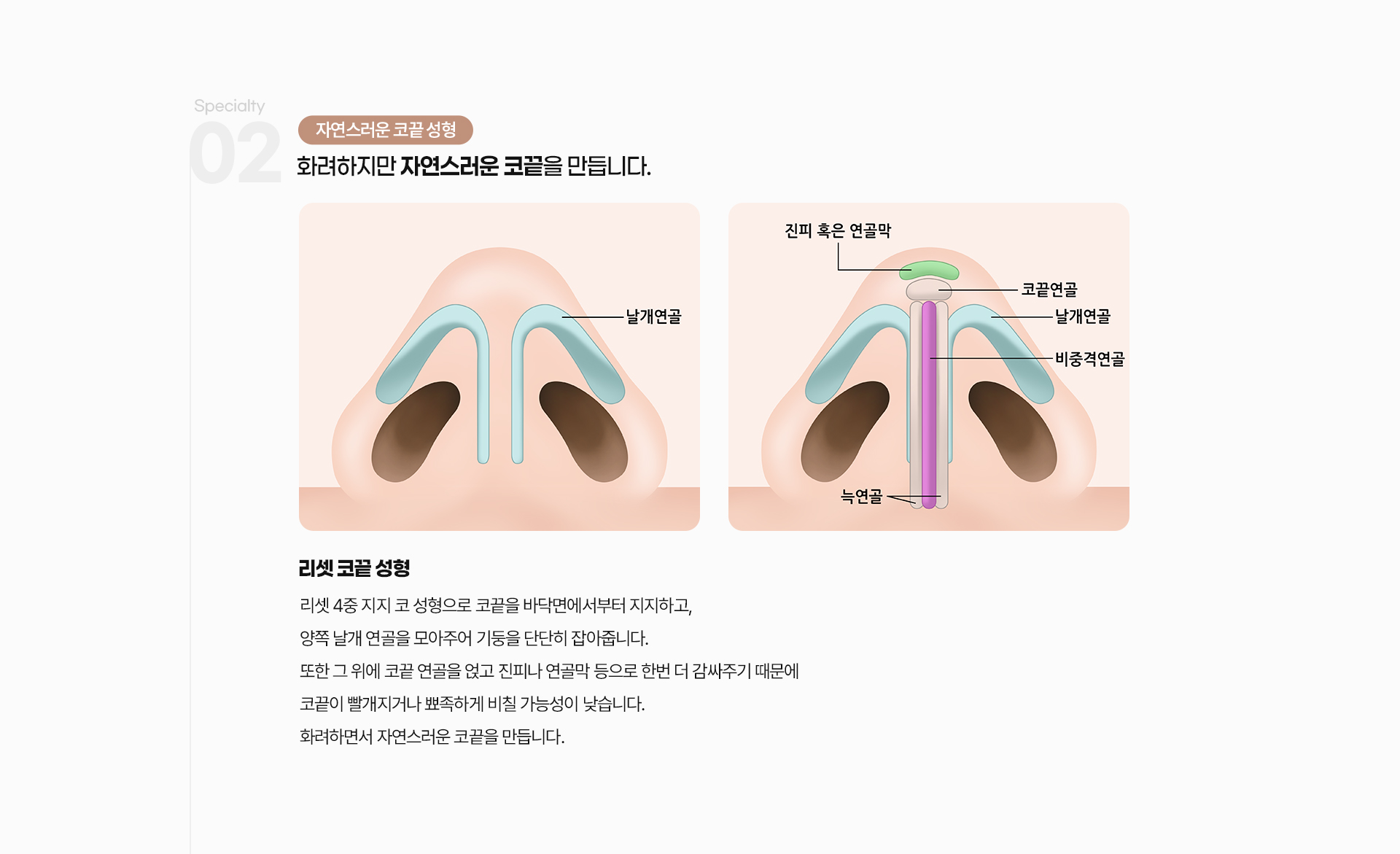 리셋코성형 04