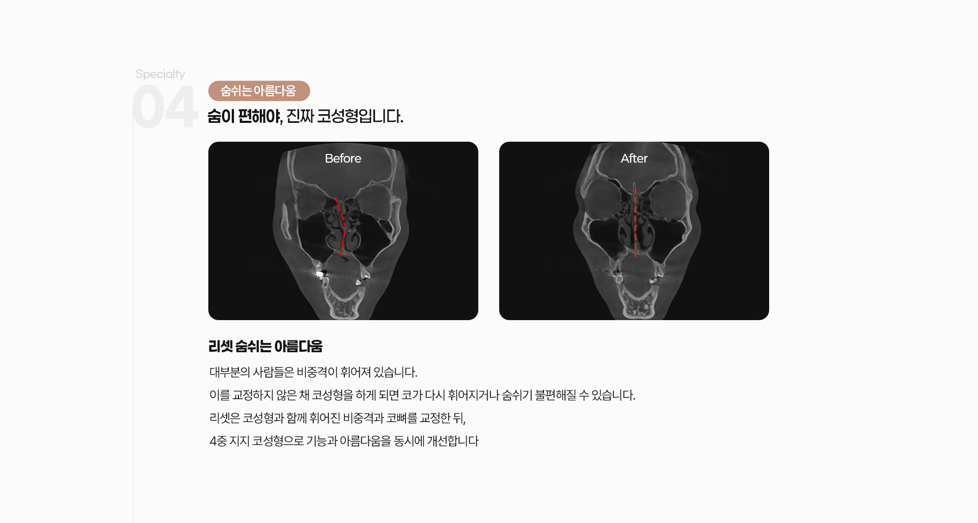 리셋코성형 06
