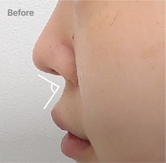 균형 잡힌 비순각