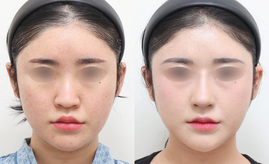 전후사진_정면