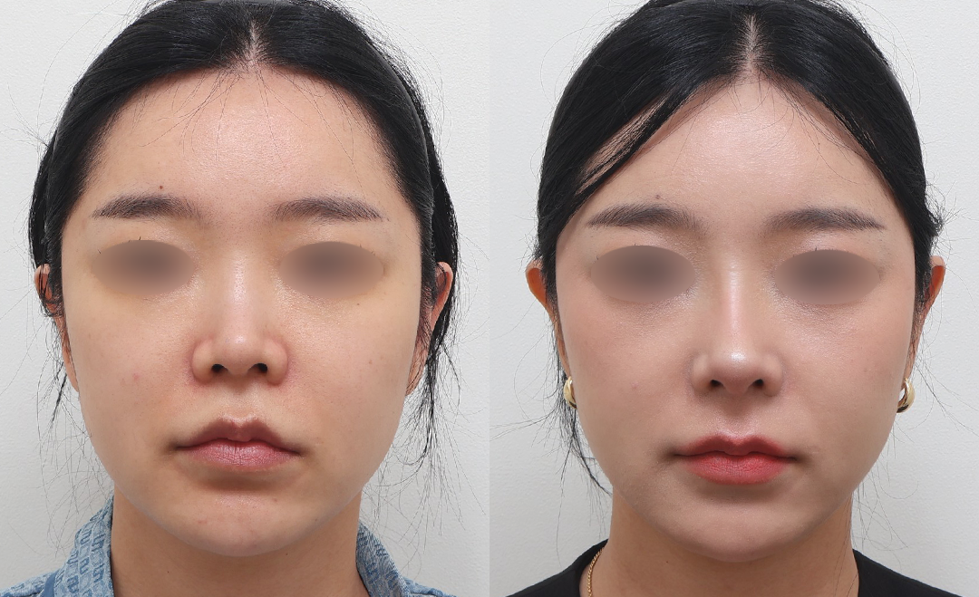 전후사진_정면